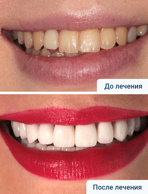 Имплантация жевательной группы зубов. Эстетическое протезирование верхней и нижней челюсти безметалловыми коронками