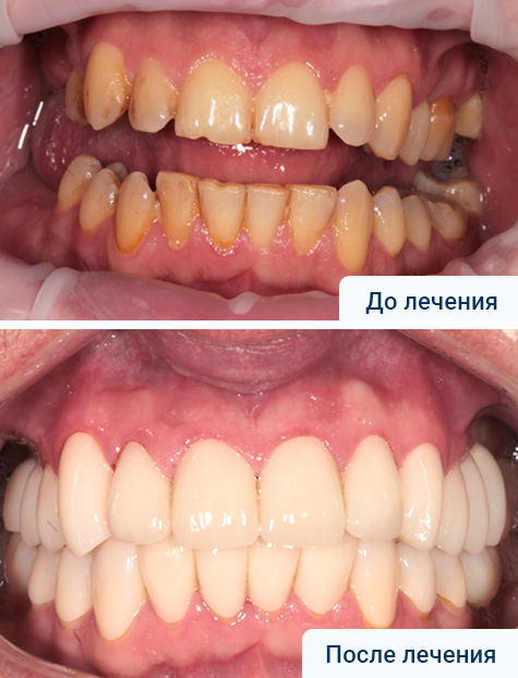 Имплантация жевательной группы зубов. Эстетическое протезирование верхней и нижней челюсти безметалловыми коронками
