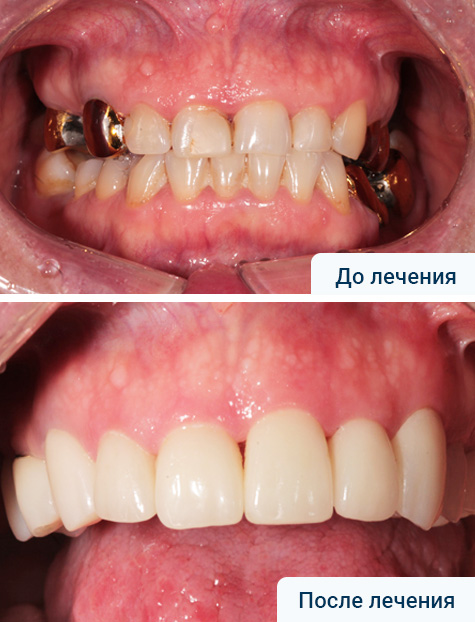 Имплантация жевательной группы зубов. Эстетическое протезирование верхней челюсти безметалловыми коронками