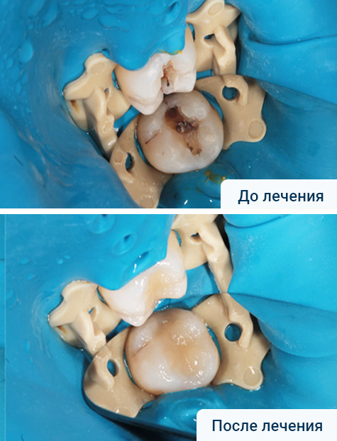 Лечение кариеса с восстановлением анатомии зуба
