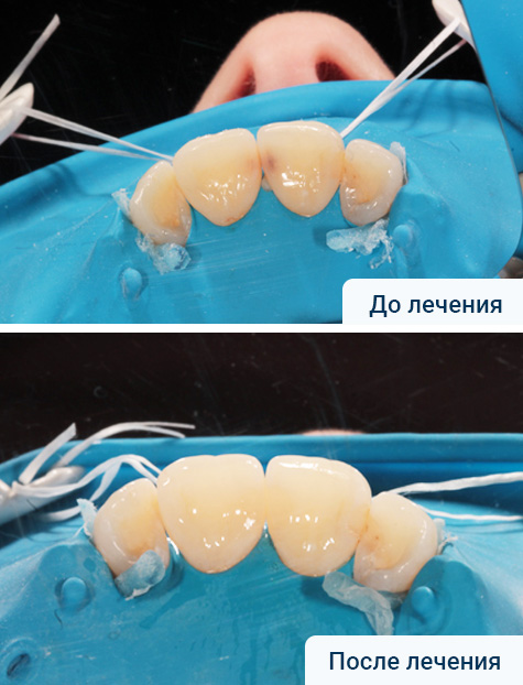 Лечение кариеса и эстетическая реставрация фронтальных зубов
