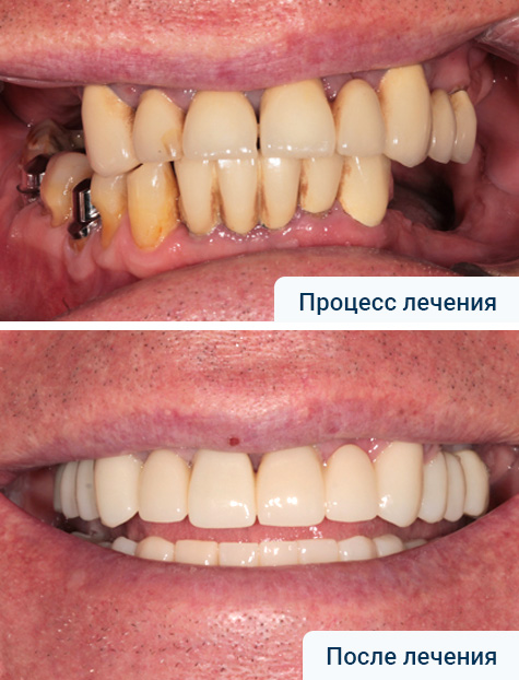 Нижняя челюсть - Имплантация по протоколу All-on-6. Верхняя челюсть - имплантация жевательной группы зубов и эстетическое протезирование коронками диоксид циркония